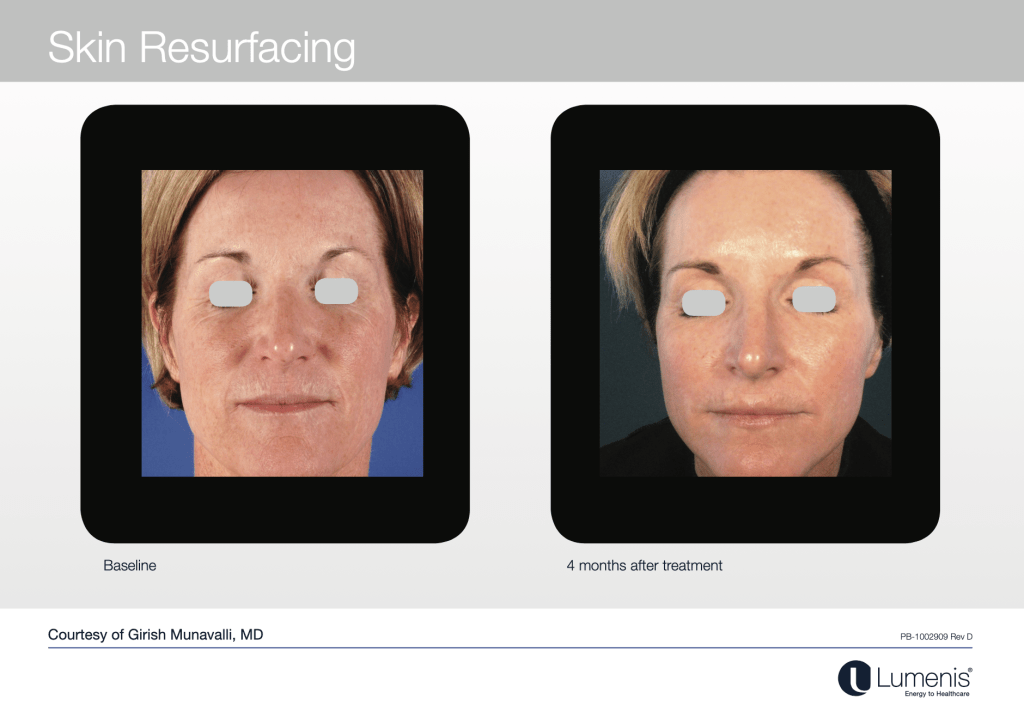 CO2 Laser Skin Resurfacing Philadelphia - The Lumen Center